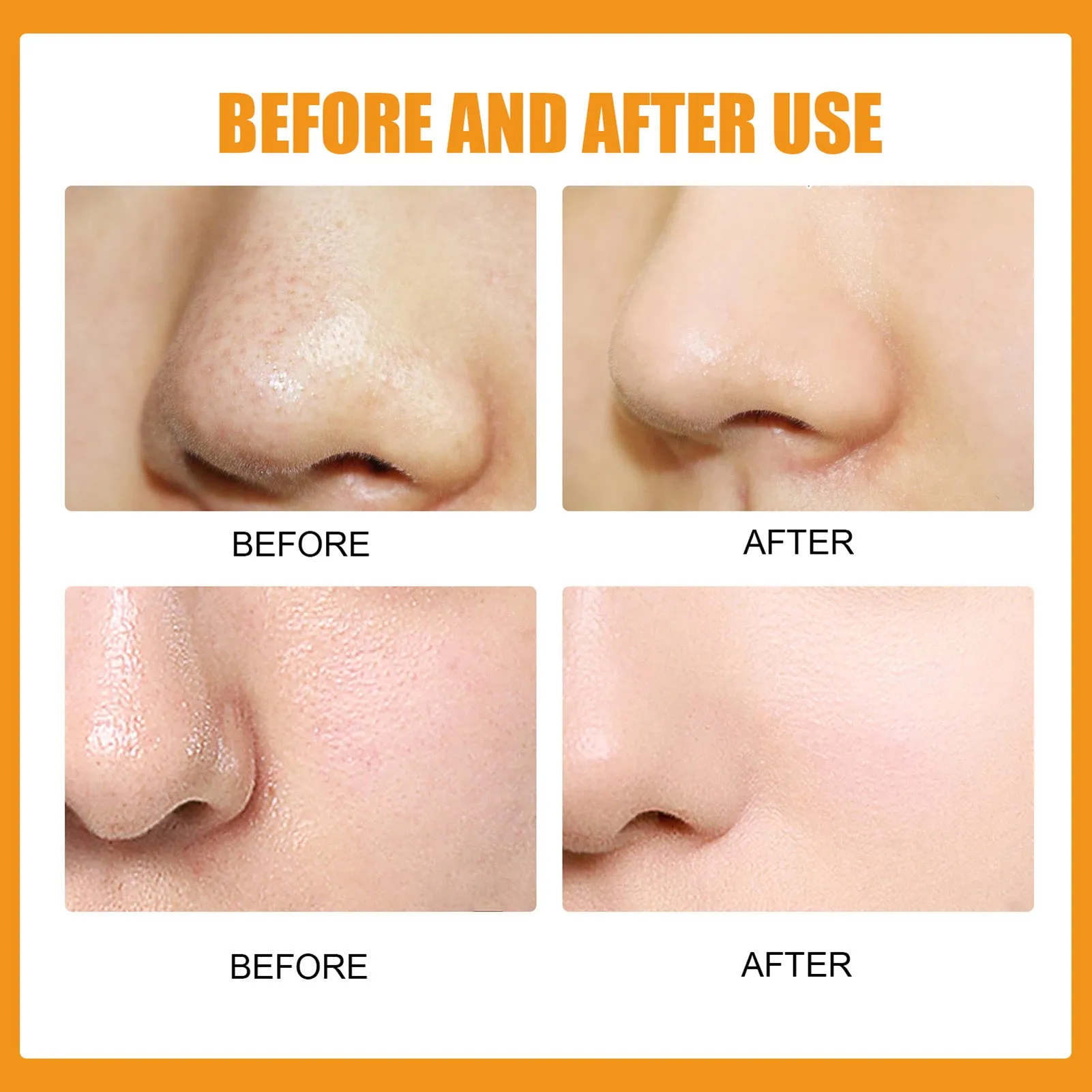 EELHOE Hydrocolloid Nose Patches